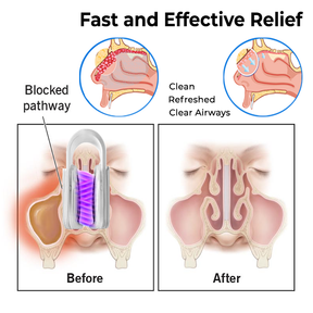 Oveallgo™ Nasal Mucus Cleaning Device